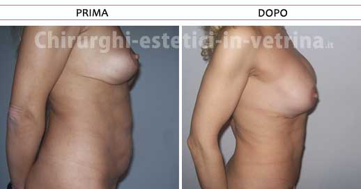 Addominoplastica prima e dopo - Caso 1. Chirurgo estetico dr. Claudio Toniolo