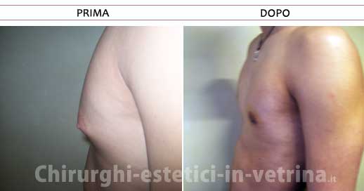 Ginecomastia prima e dopo - Caso 1. Chirurgo estetico dr. Claudio Toniolo