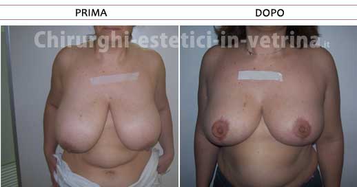 Mastopessi prima e dopo - Caso 1. Chirurgo estetico dr. Claudio Toniolo
